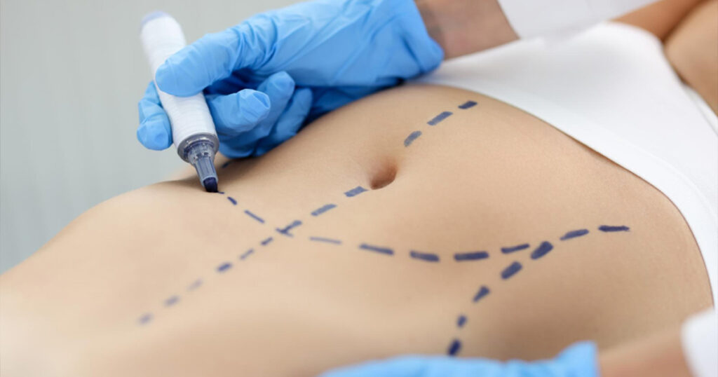 Cirurgia estética corporal