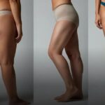 Lipoenxertia íntima antes e depois: veja resultados reais e o que esperar