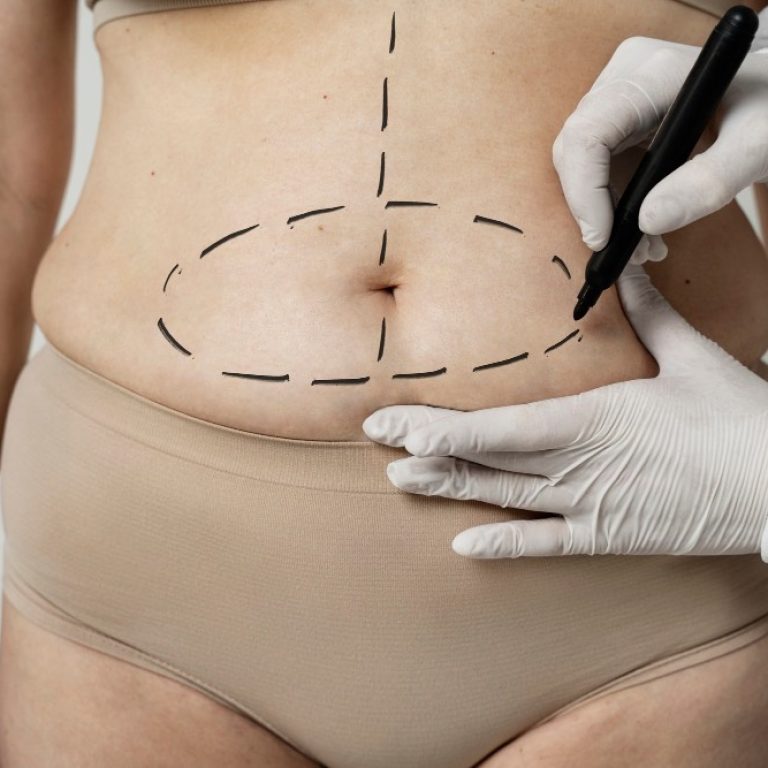 Abdominoplastia em âncora