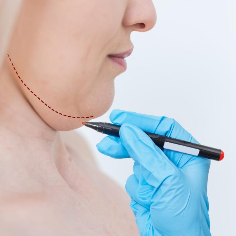 Lipoaspiração de papada