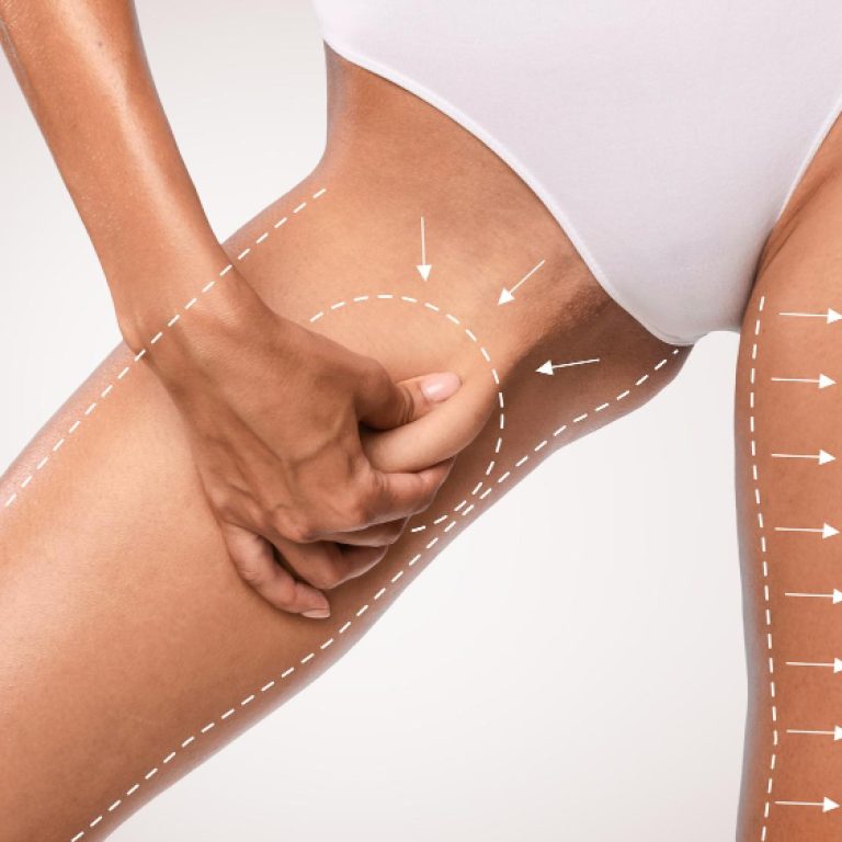 Lipoaspiração medial (interna) da coxa