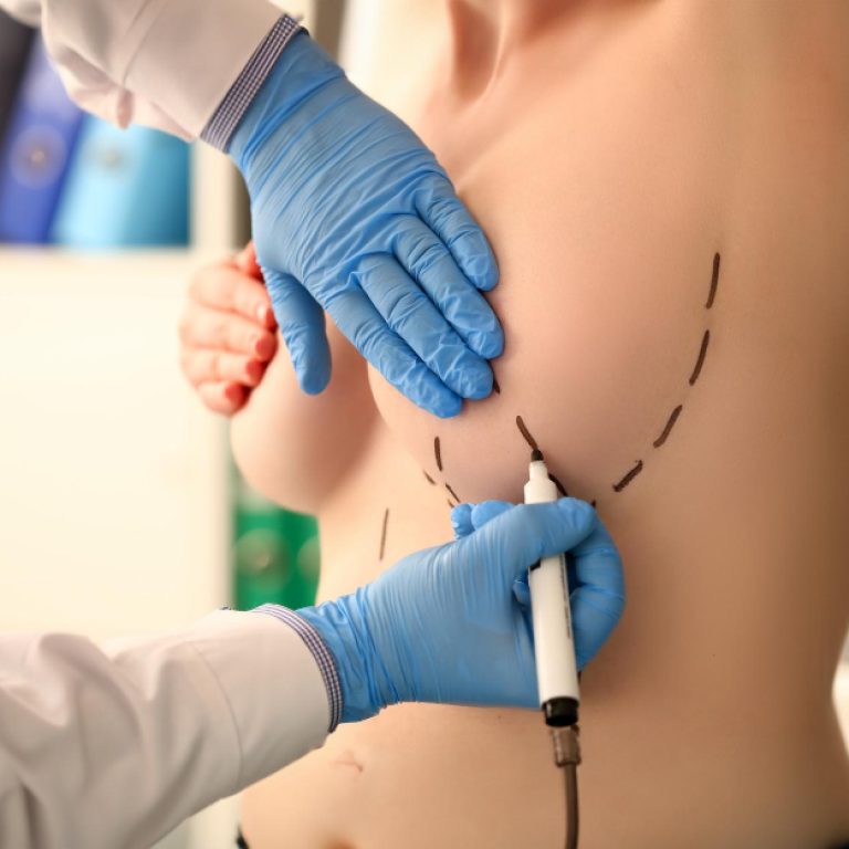 Lipoenxertia de mama