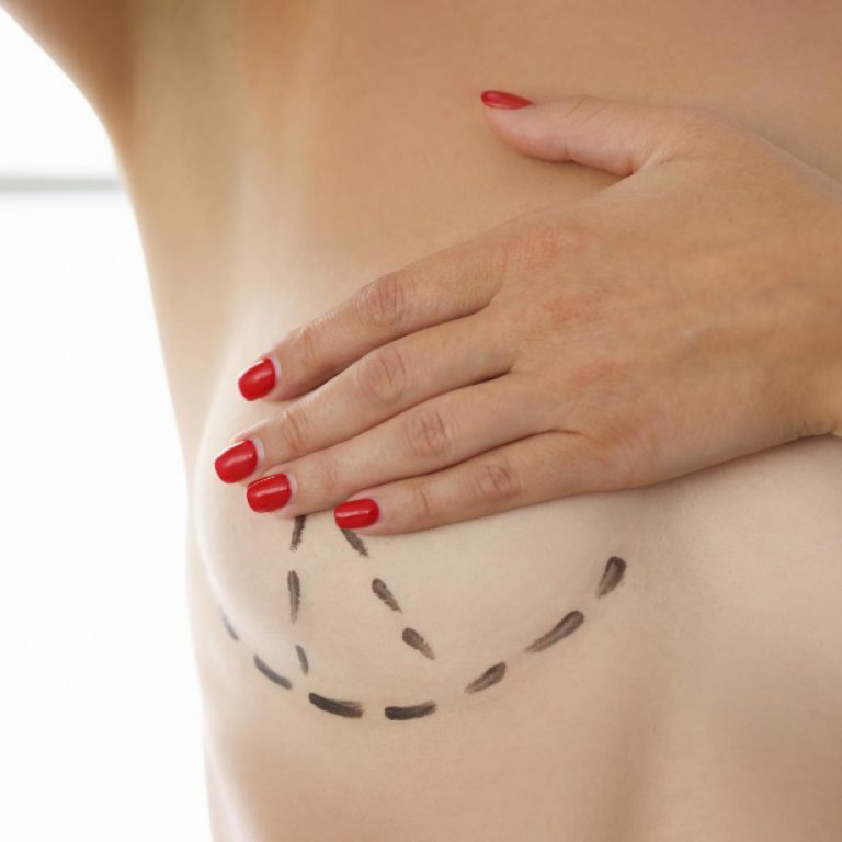 Mastopexia short scar