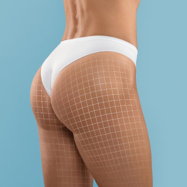 Remodelação glútea